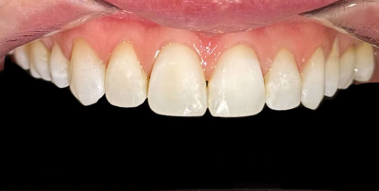 After Invisalign case 1