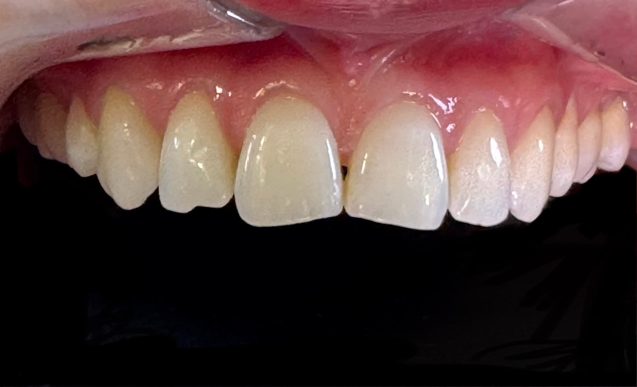 Before Invisalign case 1